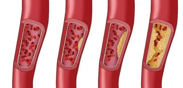 血管堵,"手脚"先知,喝好三杯水,常动四处,疏通血管,防血栓