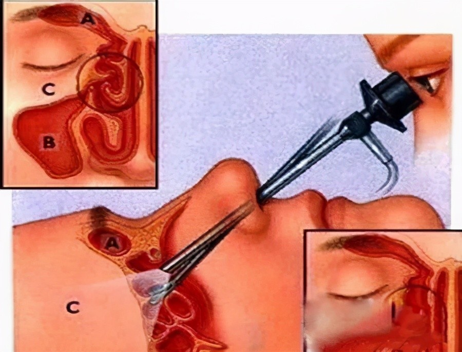 女子鼻塞流鼻涕 以为是感冒 结果被医生告知鼻子里长了 荔枝 全网搜