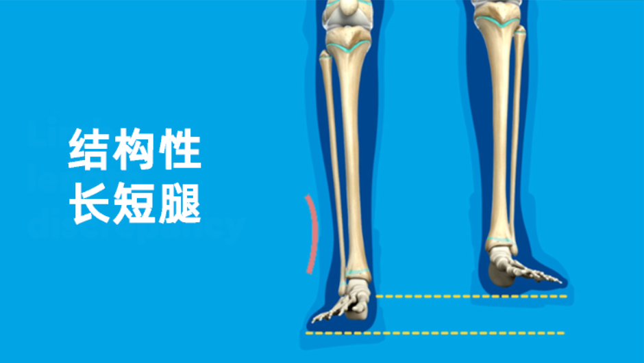 你以为的脊柱侧弯 可能是假的 腾讯新闻