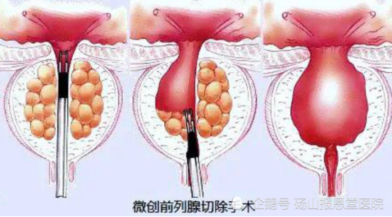 前列腺增生怎么治疗最好的方法视频 _前列腺增生怎么治疗-第2张图片-潮百科