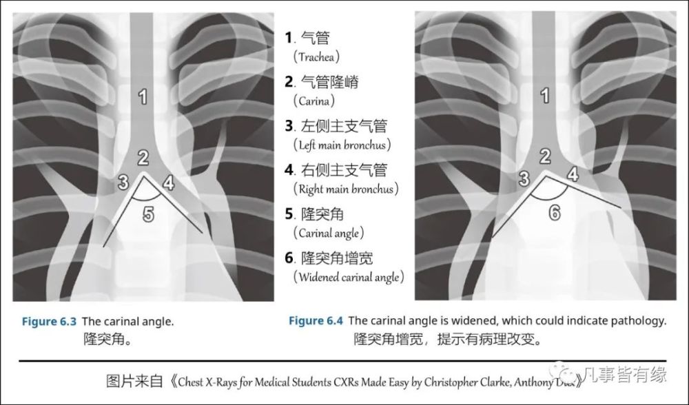 3,嵴下角(subcarinal angle):(1)氣管中線與主支氣管下緣間的夾角稱嵴