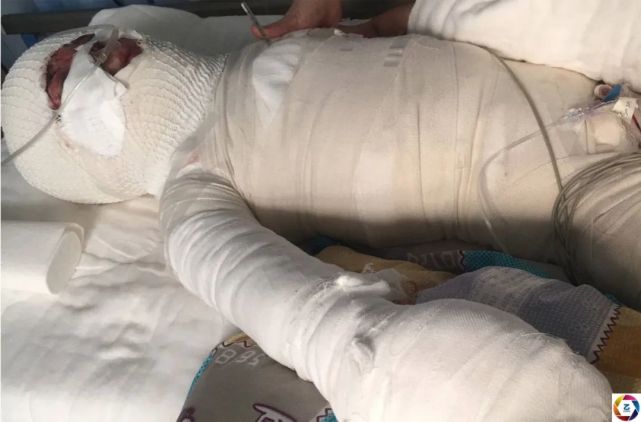 一顿火锅引发的悲剧:6岁漂亮女童瞬间被火吞噬,痛苦伴随一生_腾讯新闻