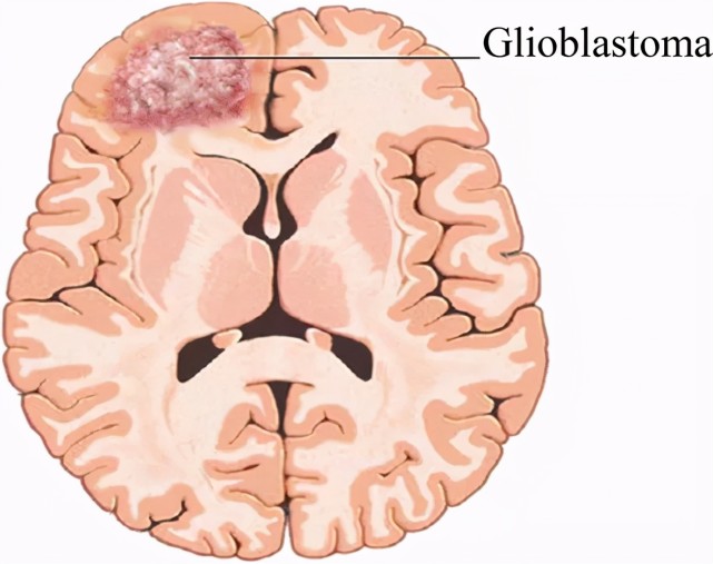 盤點膠質母細胞瘤七大前沿治療,inc加拿大rutka教授解讀新突破