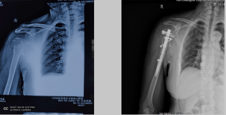 常德市二醫院成功開展multiloc髓內釘治療肱骨近端粉碎性骨折