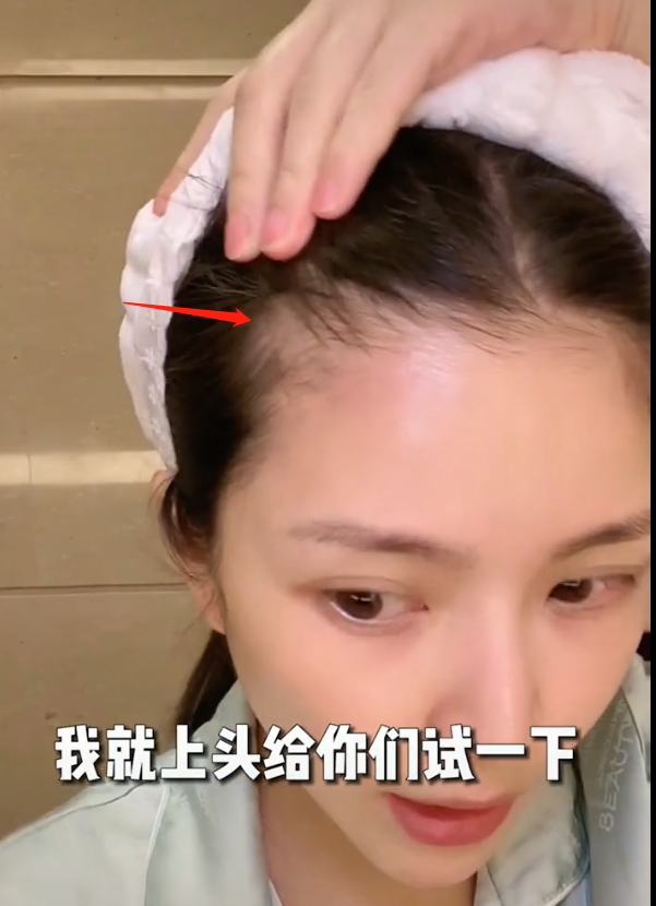 杜淳老婆自曝怀孕产女后脱发严重,发缝变宽发际线后移,出门要靠粉遮挡