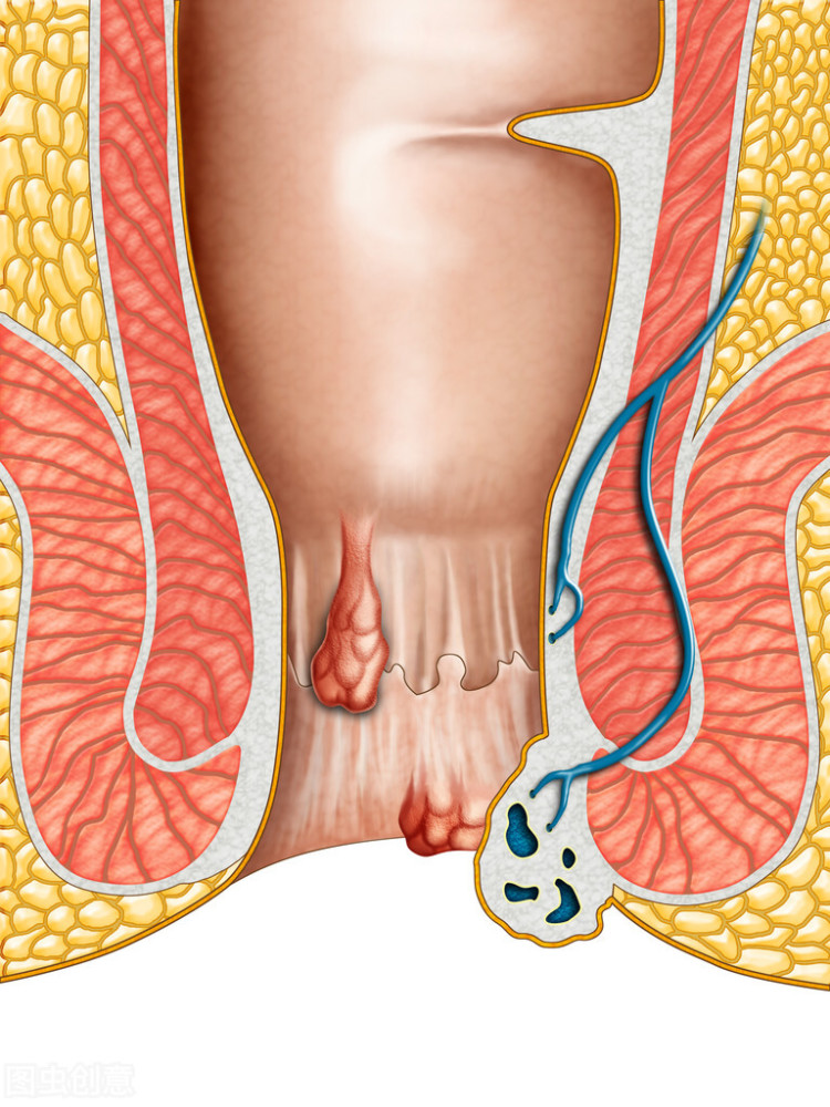 不想得痔疮 教你的方法单又实用 腾讯新闻