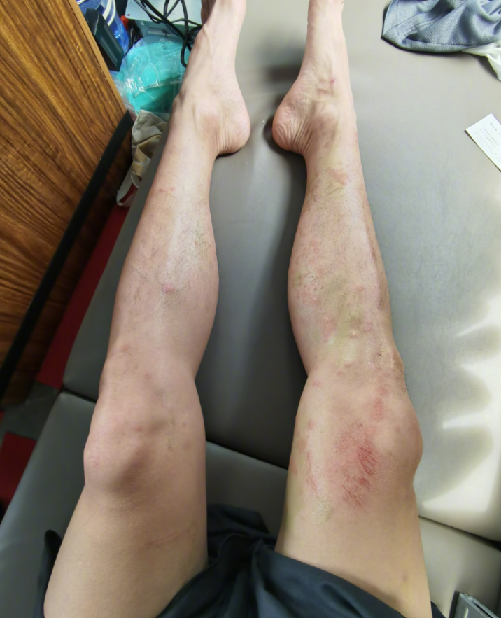 作为一个帅气男演员,皮肤受伤这么严重,估计很难不影响到工作.