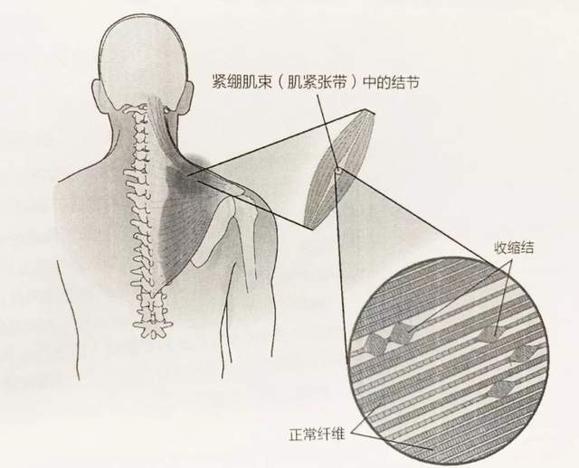 金莎按摩过度导致筋膜黏连,在康复过程中,需要注意这些!