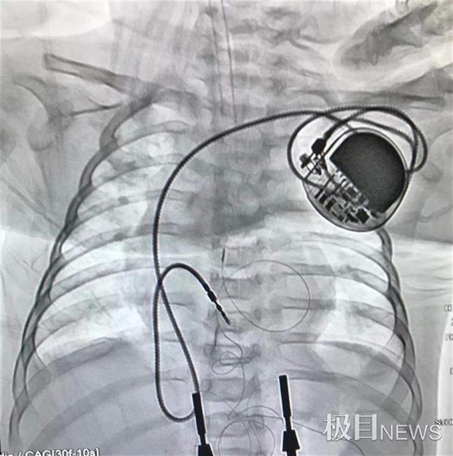 心跳太緩慢4個月先心病寶寶植入永久性心臟起搏器