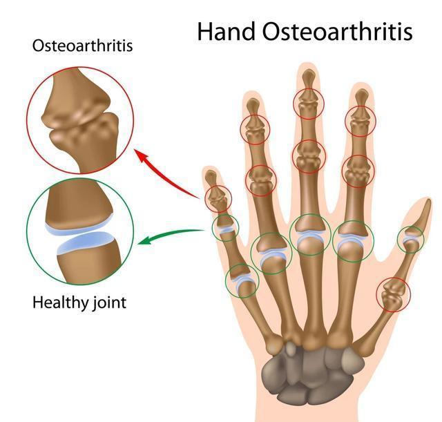 手指关节疼痛僵硬可能和疾病有关看看医生怎么说