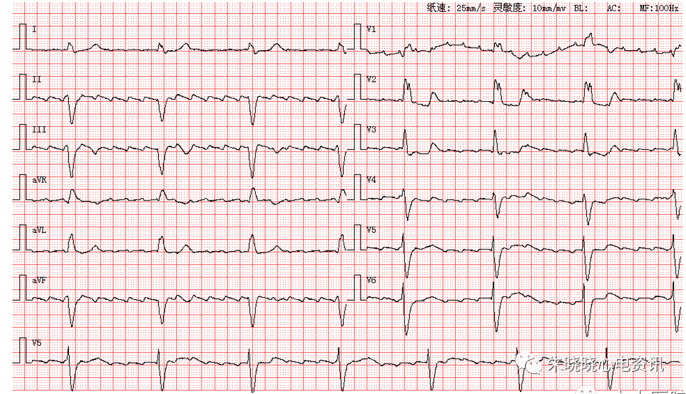 每日读图第1404期房扑伴三度房室传导阻滞室性逸搏心律