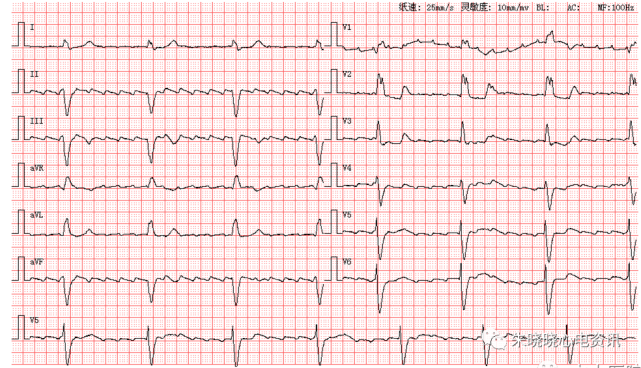 每日读图第1403期窦缓左心室高电压房早