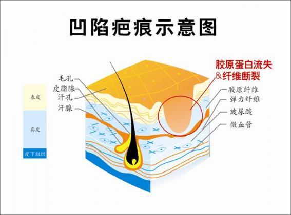 凹陷性疤痕,是皮肤真皮层及皮下组织缺损而造成的伤疤.