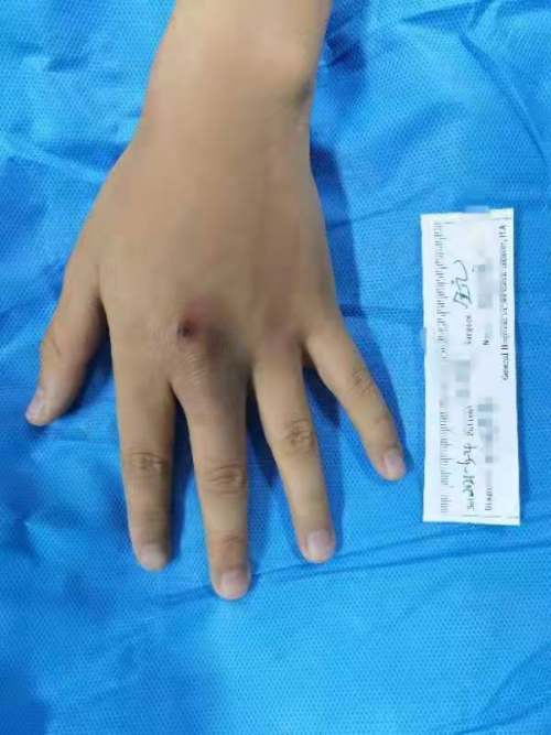 沈阳男孩被体温计划伤,水银残留手部住进医院