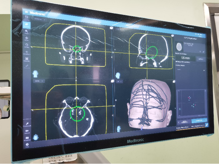 北京医院神经外科手术再添利器新一代手术导航系统精准引路