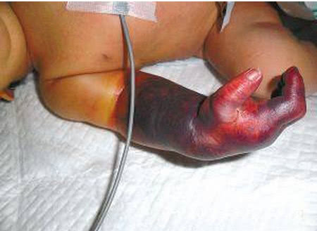 出生十天的婴儿,被奶奶"五花大绑",致使右臂坏死酿悲剧!