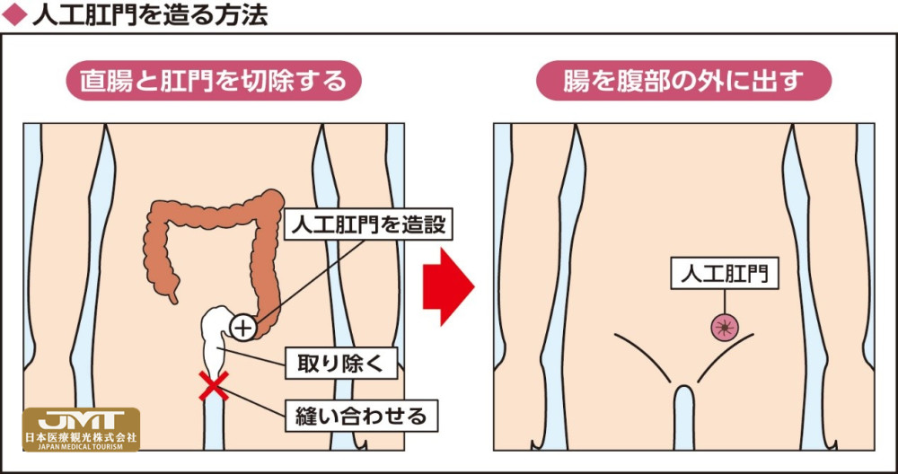 jmt日本医疗-人工肛门也能正常生活,请积极乐观享受人生