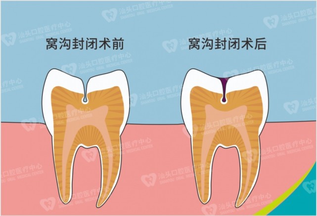 除了窩溝封閉外便是 塗氟