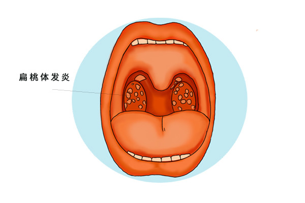 總而言之,雖然eb病毒感染和普通的發燒感冒症狀差不多,但是用心觀察