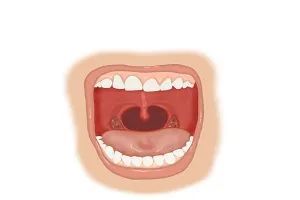 咽峡,是口咽部一个狭窄的环形结构,由悬雍垂,腭帆后缘,左右腭舌弓