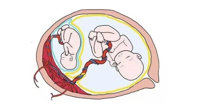 孕中期产检时,双胞胎被发现患有选择性胎儿生长受限,两个胎儿体重相差