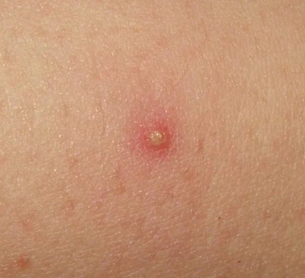 身上长包很常见有些包可不能掉以轻心