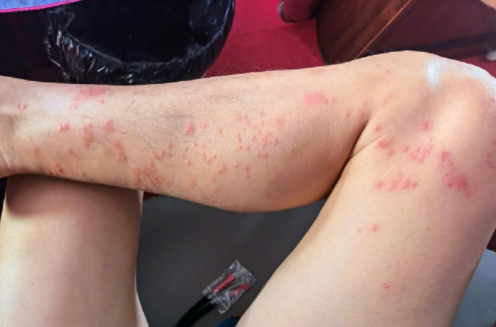 被蜱虫叮咬后险些丧命!户外出行一定要注意