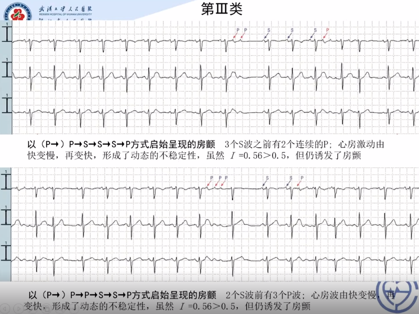 房顫發作之前心電圖是什麼樣的