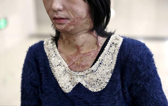 高一女孩周岩因拒绝富二代追求便被泼了汽油后来术后获重生