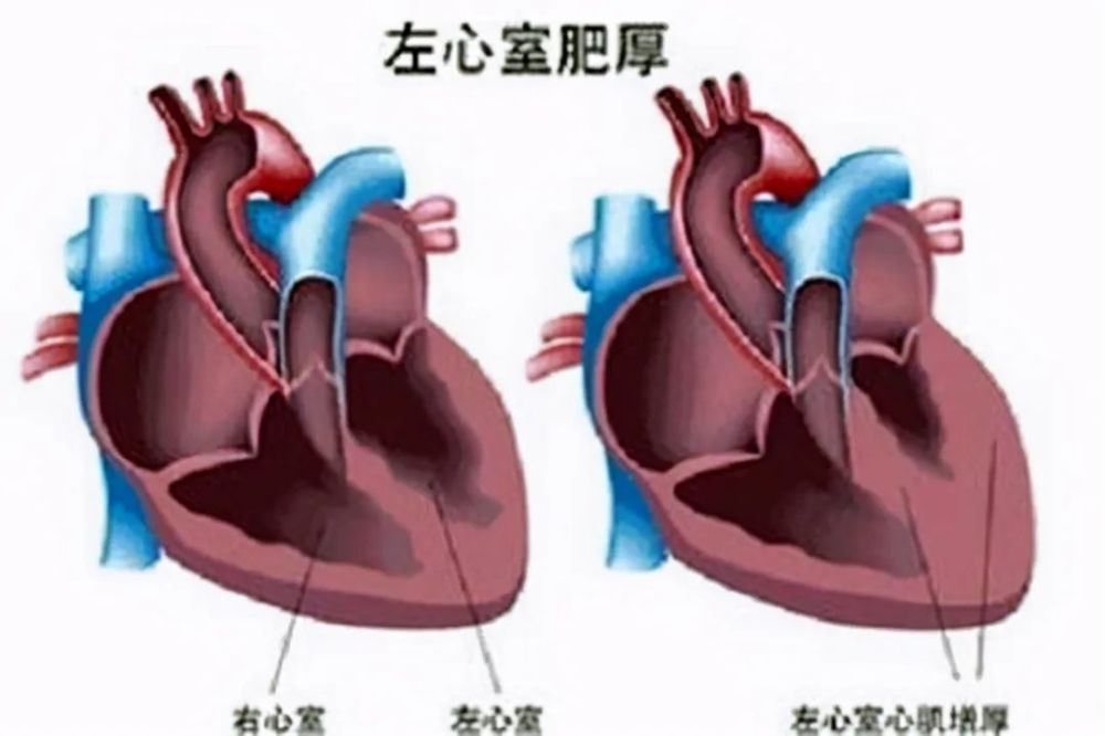 心室间隔12mm,左心室后壁13mm,这是明显肥厚了,舒张功能也减低了(高