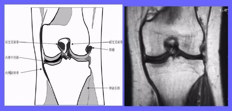 半月板損傷的mri分級及檢查骨科基礎