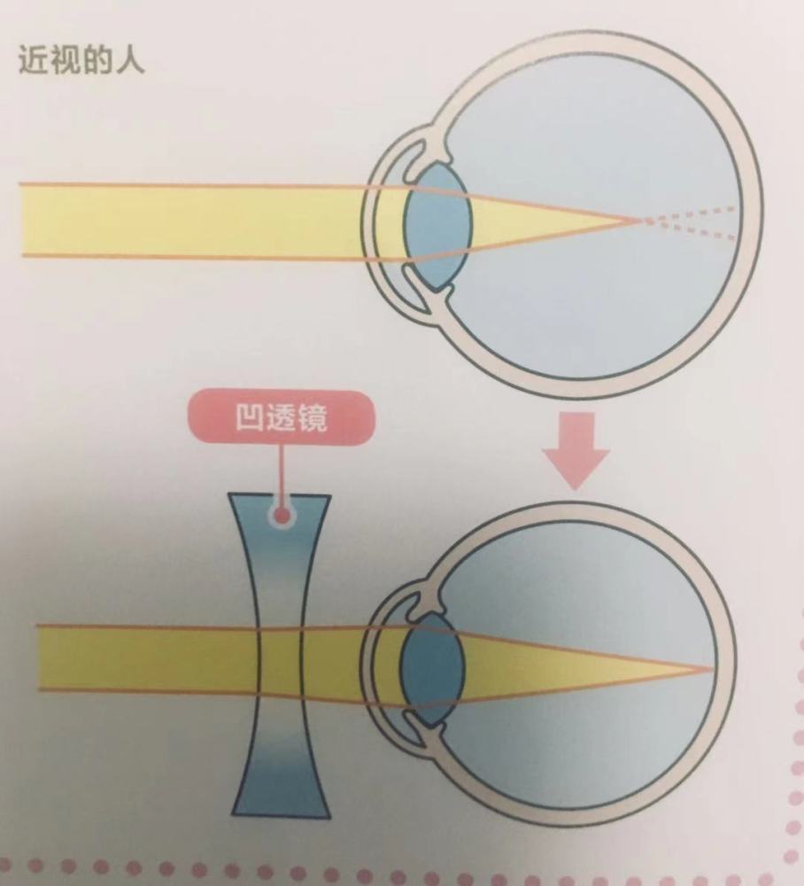 孩子近视,散光的原因又是什么?