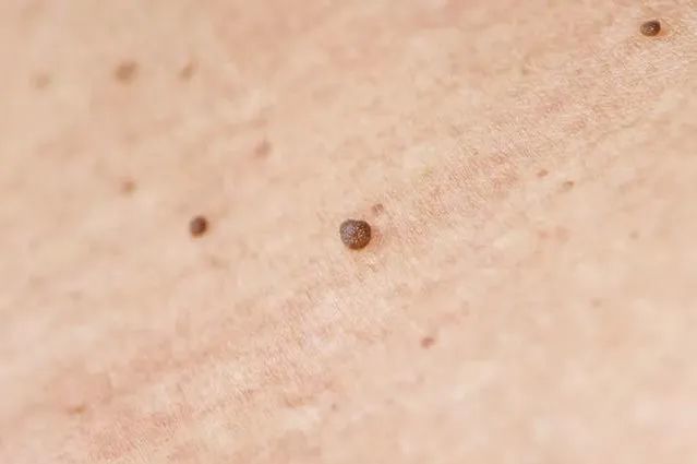在皮肤上会出现一些大小不一样的红色疣体