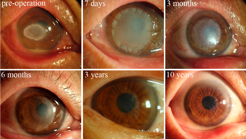 世界首例!猪肾成功移植人体,猪不仅好吃还能救命