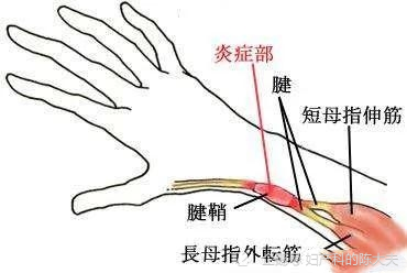 你知道嗎?不止是鍵盤俠,新手媽媽也容易得腱鞘炎哦