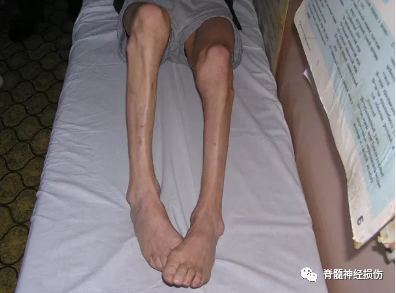 下肢出现肌肉萎缩是什么情况?