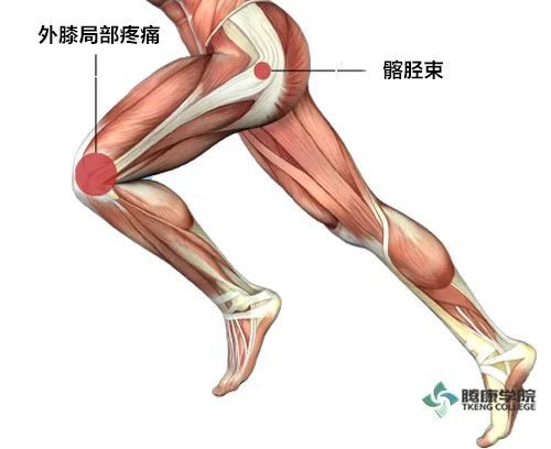 髂胫束摩擦综合征的分析与治疗 It Band综合征 腾讯新闻