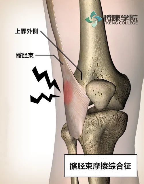 髂胫束摩擦综合征的分析与治疗 It Band综合征 腾讯新闻