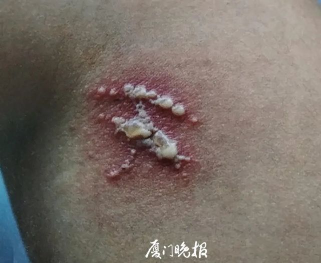 专家提醒,毒隐翅虫若落在皮肤上,要"温柔以待",轻轻吹开或弹开即可
