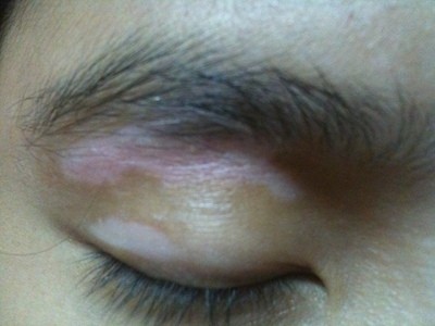 眼角上长了白癜风很多患者应该不敢盲目的治疗,毕竟眼角的白斑位置