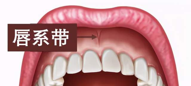 宝宝牙缝大,龋齿,是因为唇系带短?要不要手术?