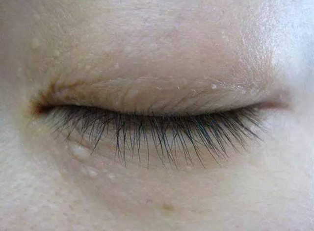 眼部护理产品,也同样可能导致皮肤对日晒敏感度上升而形成光感性皮炎