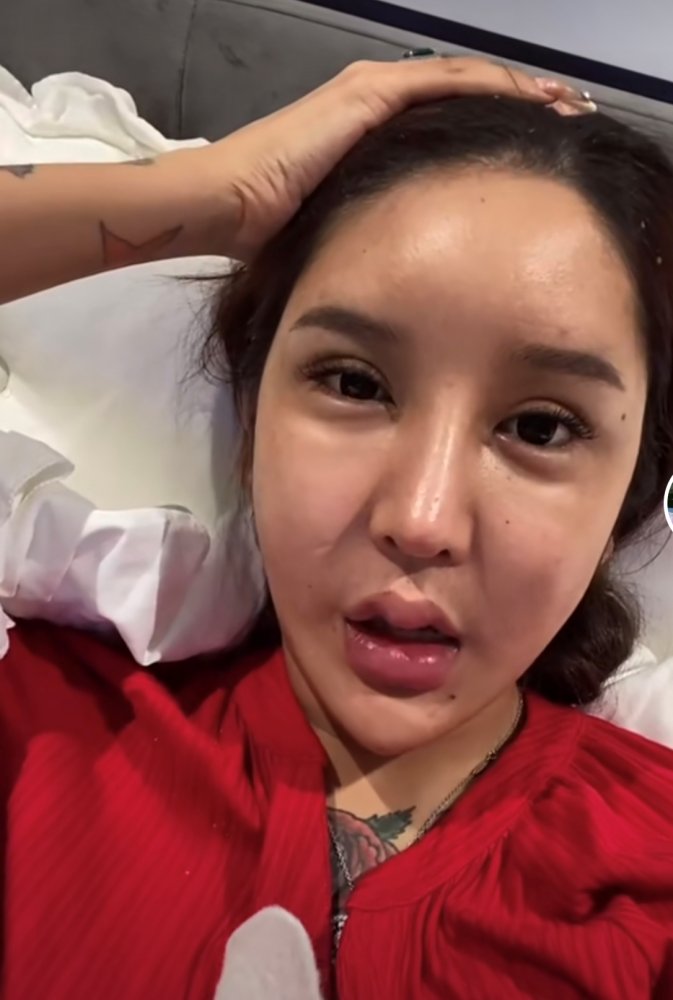 网红整容又失败花费百万额头却现巨坑曾面部神经遭压迫险失明