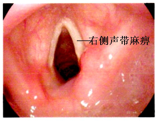 前些天,她上福建省立医院耳鼻咽喉科就诊,医生发现她的右侧声带麻痹