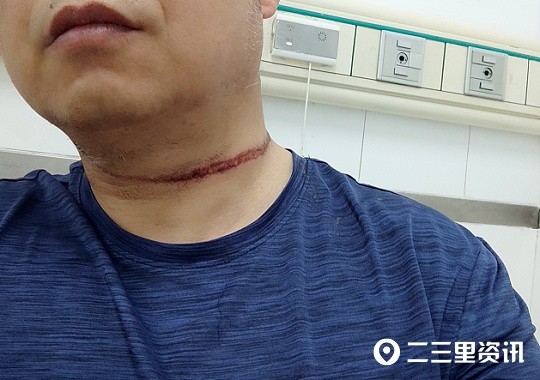 宝鸡57岁男子半夜骑车回家,被楼下私拉充电线勒伤脖子