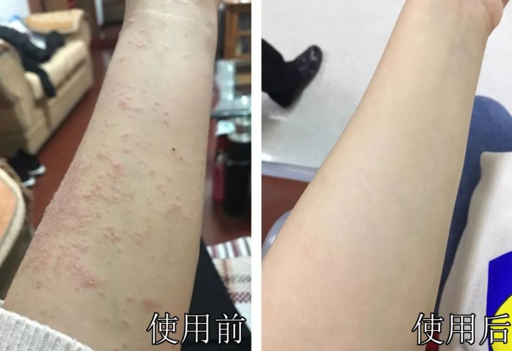 以後再也不用擔心溼疹啦~27歲的蘭蘭:每年到梅雨季節,手上溼疹就開始