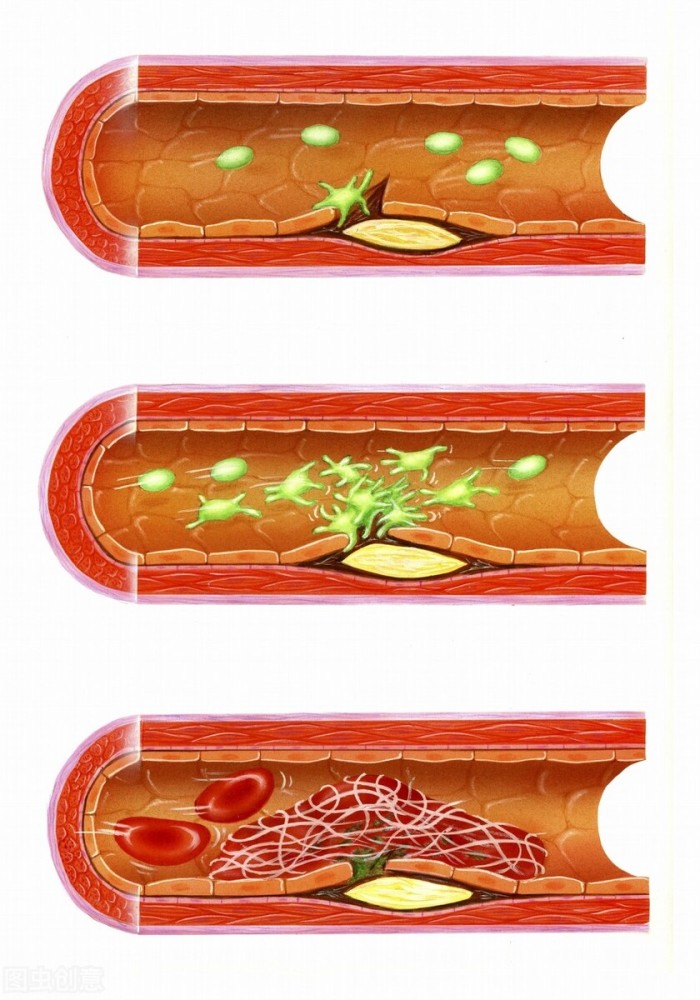 比如冠心病人发生心绞痛,心肌梗死,脑血管病人发作脑缺血,或者脑梗死