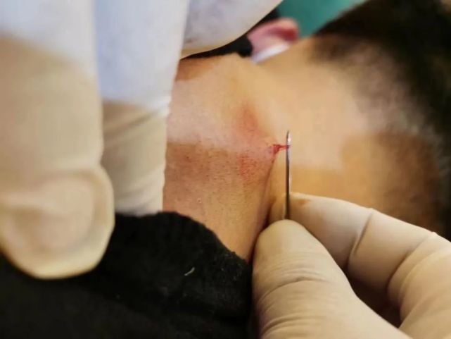 民间绝技截根疗法