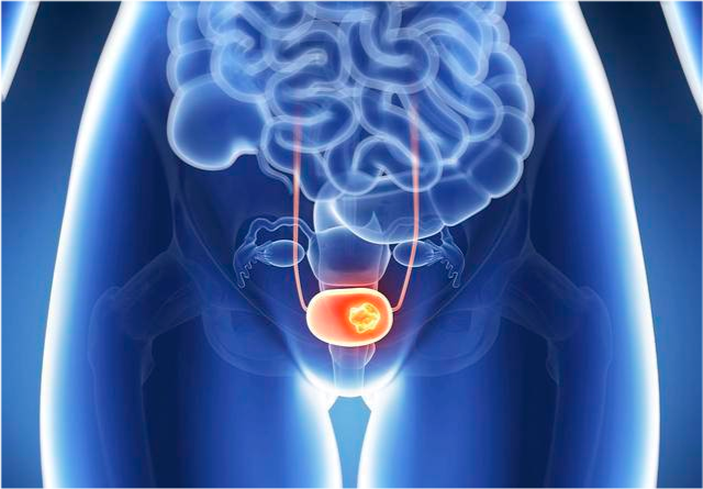 如果肿瘤侵及膀胱周围组织,如前列腺,精囊,子宫,阴道,盆壁和腹壁,或