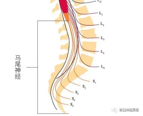 坐骨神經痛:疼痛大多表現為交替出現的坐骨神經痛,下肢甚至有局部癱瘓